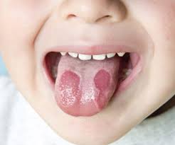 Bệnh nấm miệng candida và cách điều trị hiệu quả cho bé