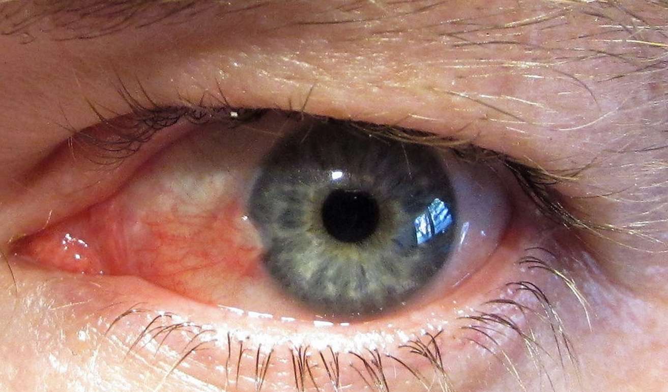 Glaucoma là bệnh lý tiến triển mạn tính, không hồi phục