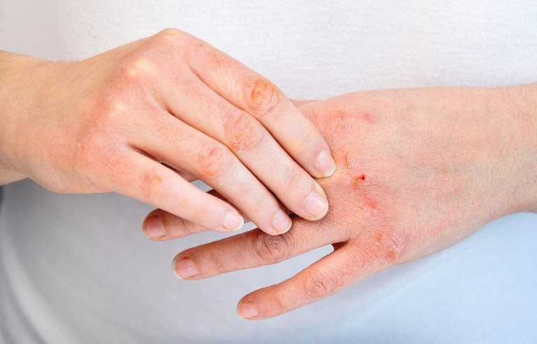 Bệnh Viêm da cơ địa có thể ảnh hưởng đến bất kỳ vùng da nào