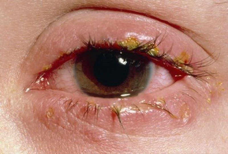 Đau mắt đỏ không điều trị kịp thời có thể dẫn đến giảm thị lực