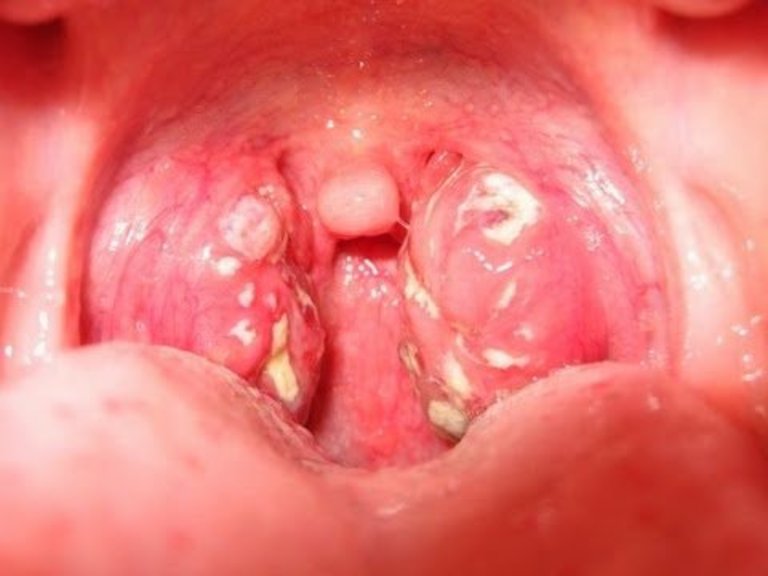 Bệnh viêm họng hạt là dạng bệnh mãn tính