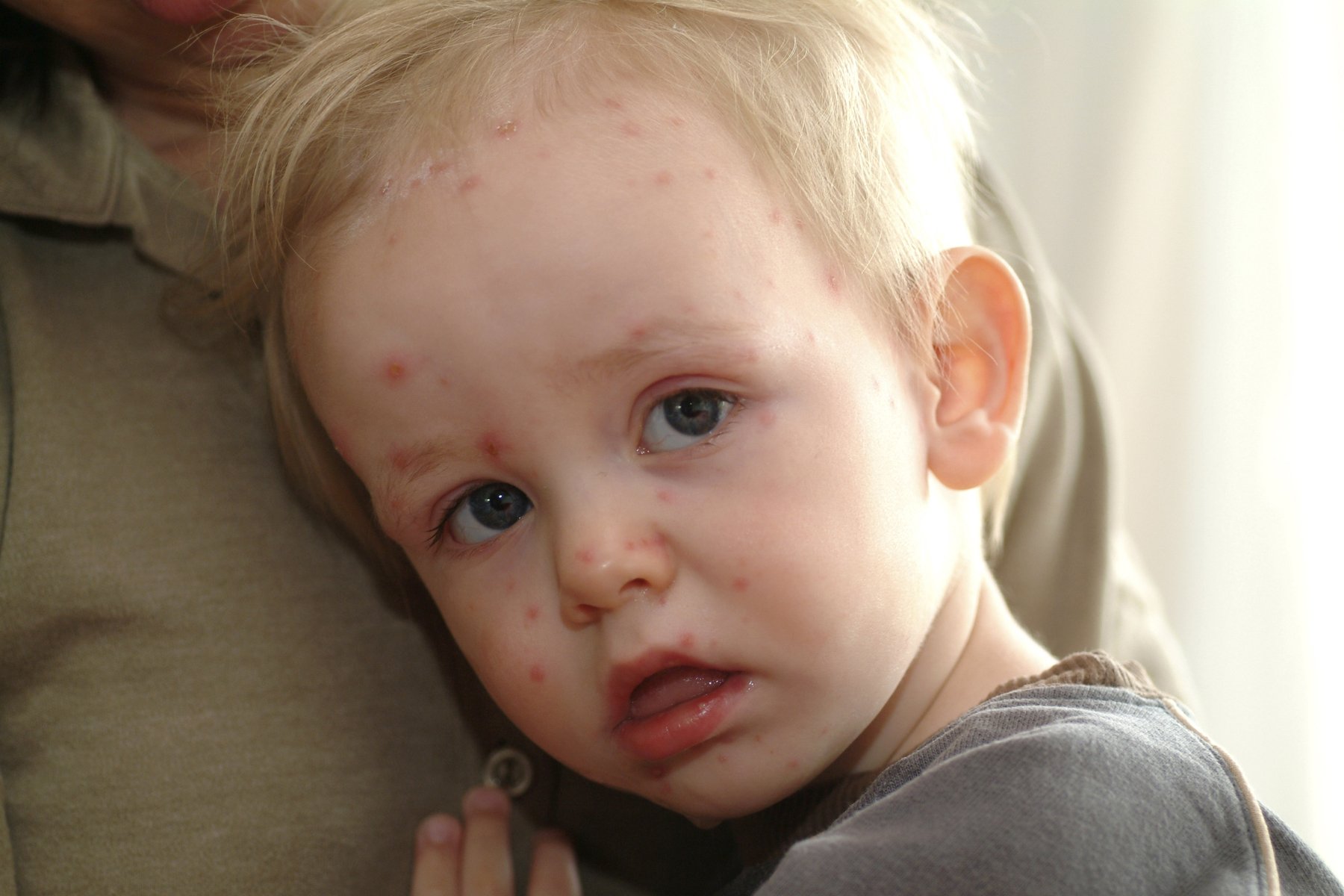 Tình trạng nhiễm virus cấp tính gọi là sốt siêu vi