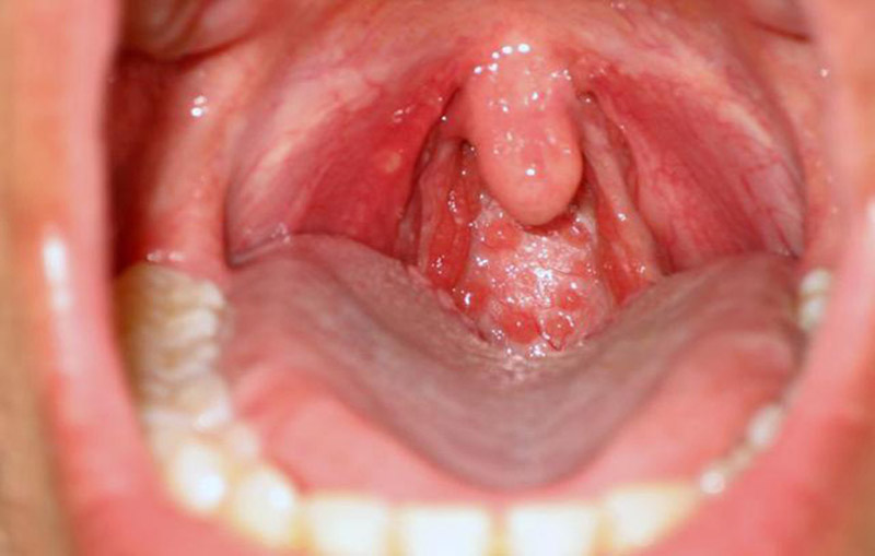 Bệnh viêm họng hạt bắt gặp ở các bệnh nhân viêm họng dai dẳng